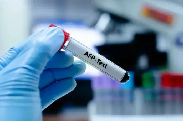 Zdjęcie Badanie AFP u mężczyzn: co oznacza i kiedy należy je wykonać?
