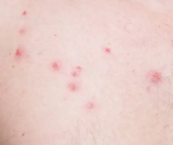 Najskuteczniejsze sposoby na pozbycie się krostek po goleniu: sprawdzone metody